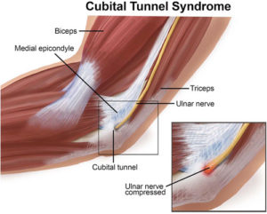 Cubital Tunnel Syndrome