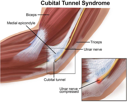 Cubital tunnel syndrome