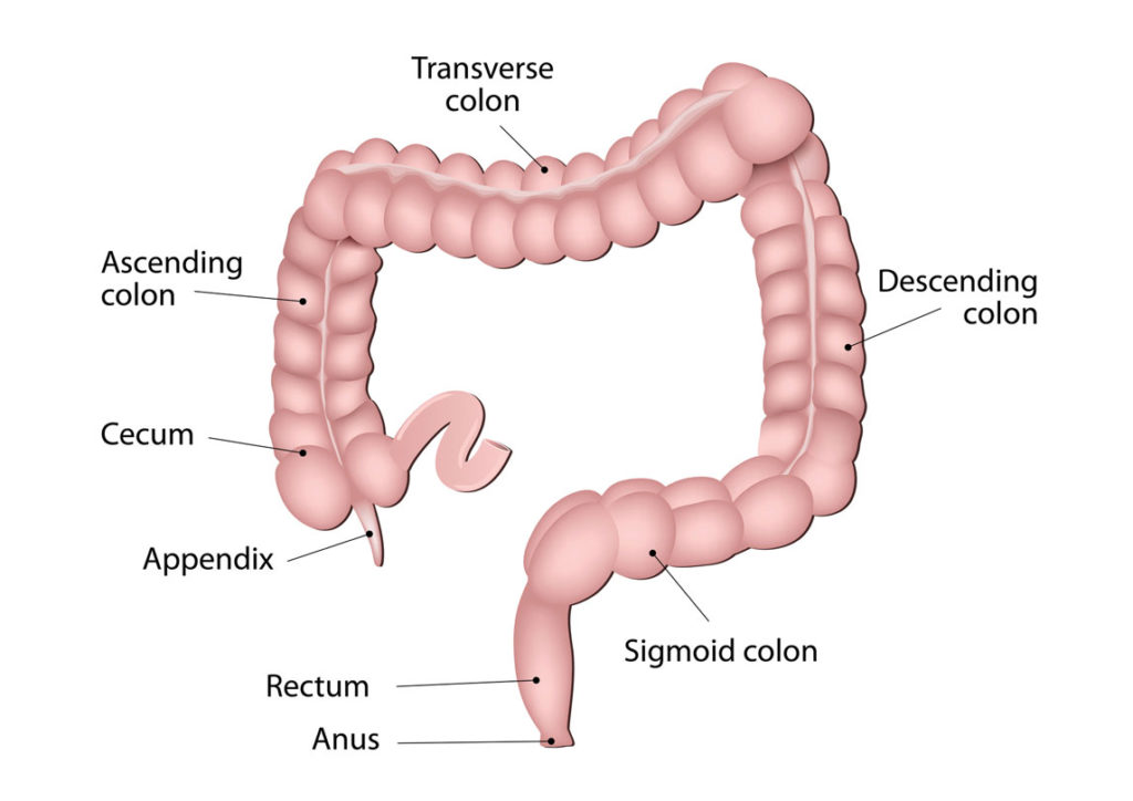 Diverticulosis